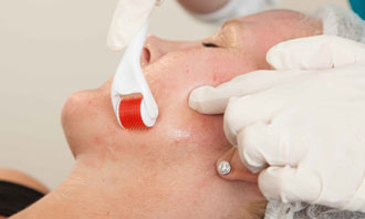 Skin-Needling-Rejuvenation-Beautify-Appearance-Adelaide